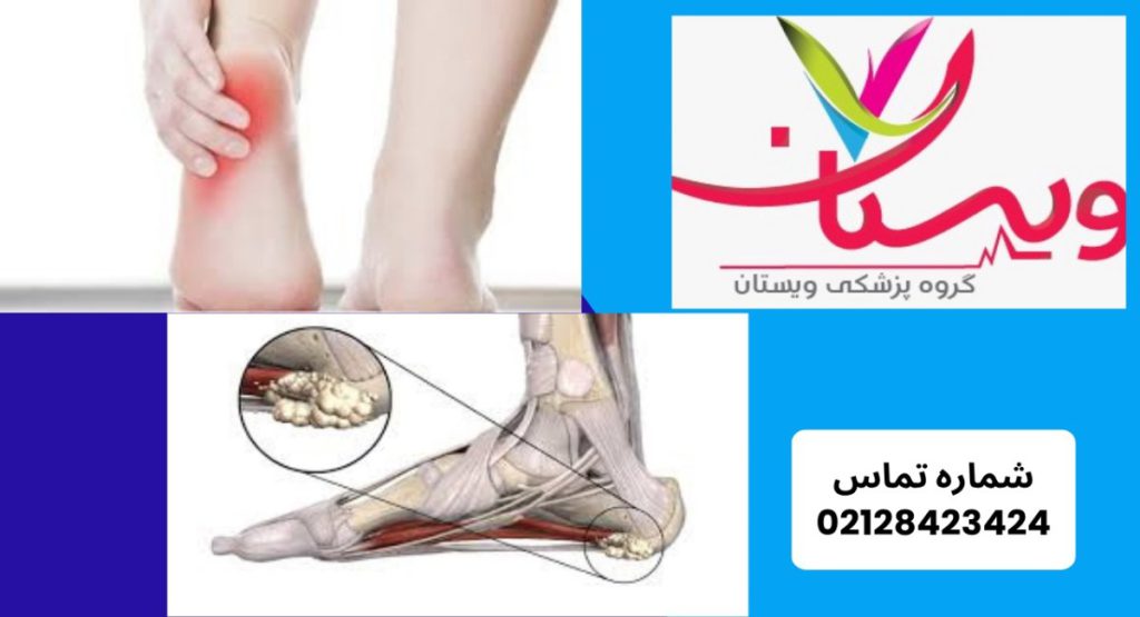 چگونه خار پاشنه تشخیص داده میشود؟ چگونه خار پاشنه تشخیص داده میشود؟