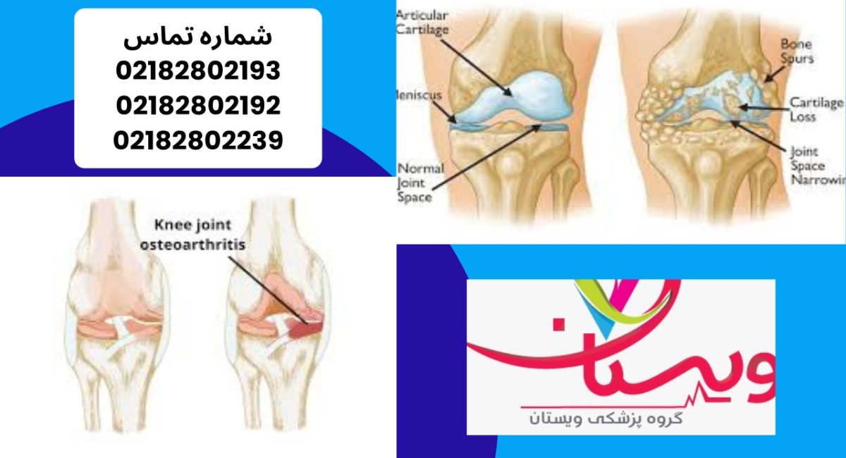 آرتروز زانو (استئوآرتریت) | علائم، درمان‌های نوین 1404