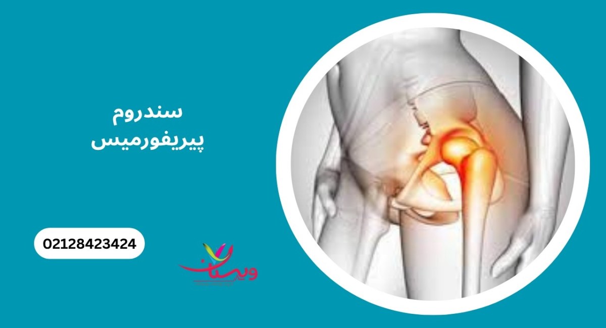 سندرم پیریفورمیس