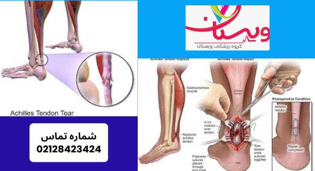 شیوع پارگی تاندون آشیل