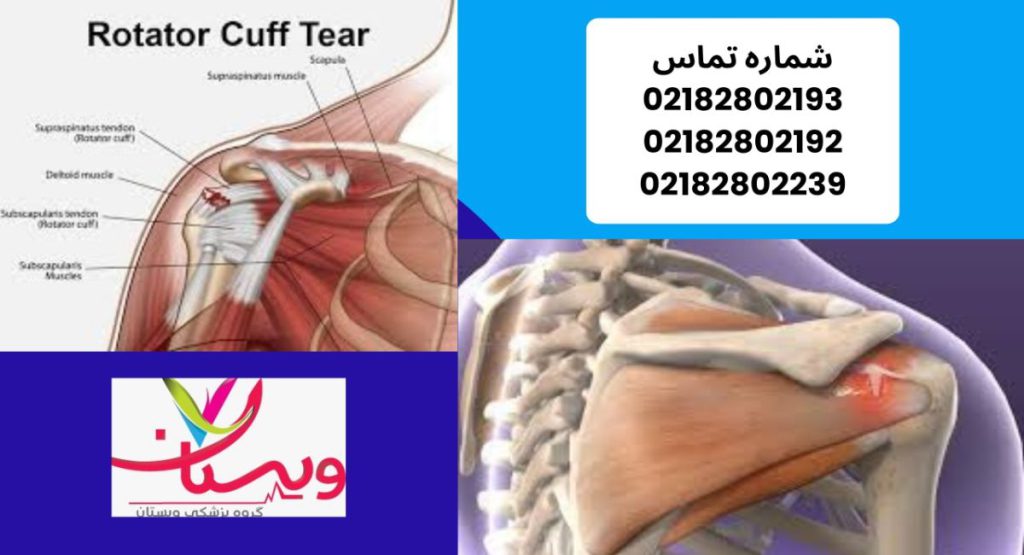 پارگی روتاتور کاف شانه | علائم، درمان و نقش کلینیک ویستان در بازگشت سلامت شانه1404