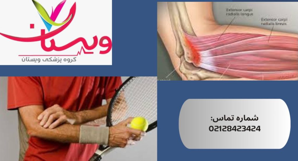 آرنج تنیس‌بازان (اپی‌کوندیلیت خارجی)| علائم، درمان قطعی و روش‌های پیشگیری 1404