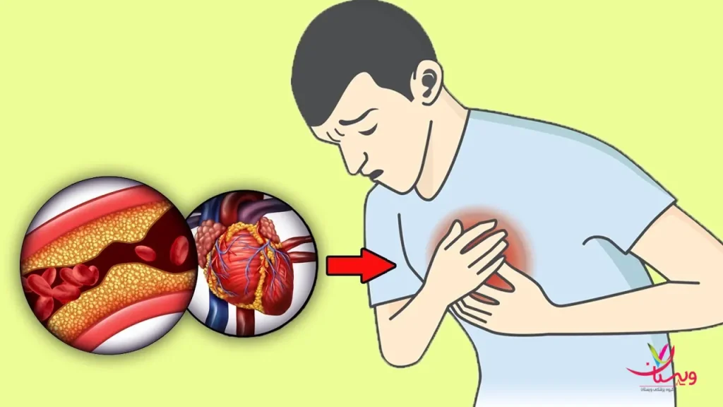 درد قلب در جوانان تفاوت سکته قلبی و حمله قلبی در پیشگیری و اصلاح سبک زندگی