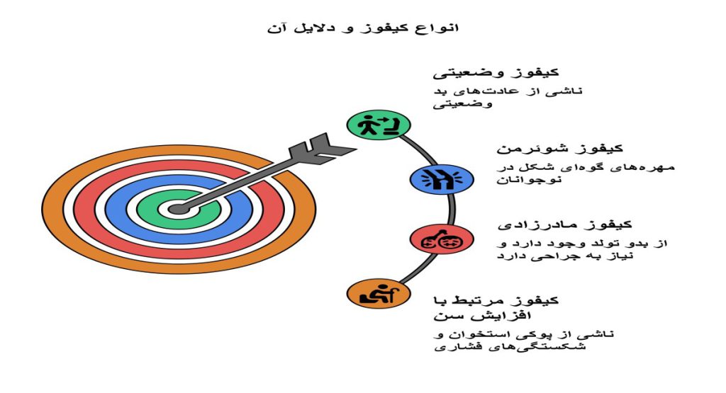 انواع کیفوز و دلایل بروز آن انواع کیفوز و دلایل بروز آن