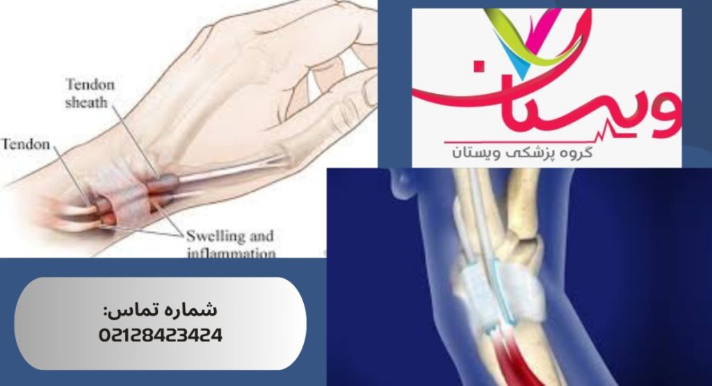 سندروم دکرون چیست؟