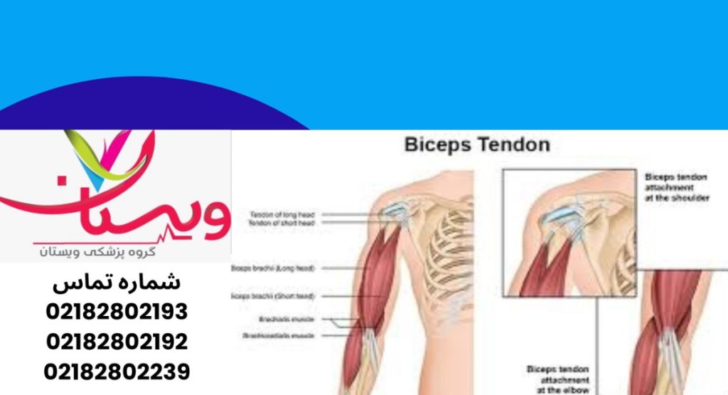 تاندونیت دوسر بازو چیست؟ تاندونیت عضله دوسر بازو چیست؟