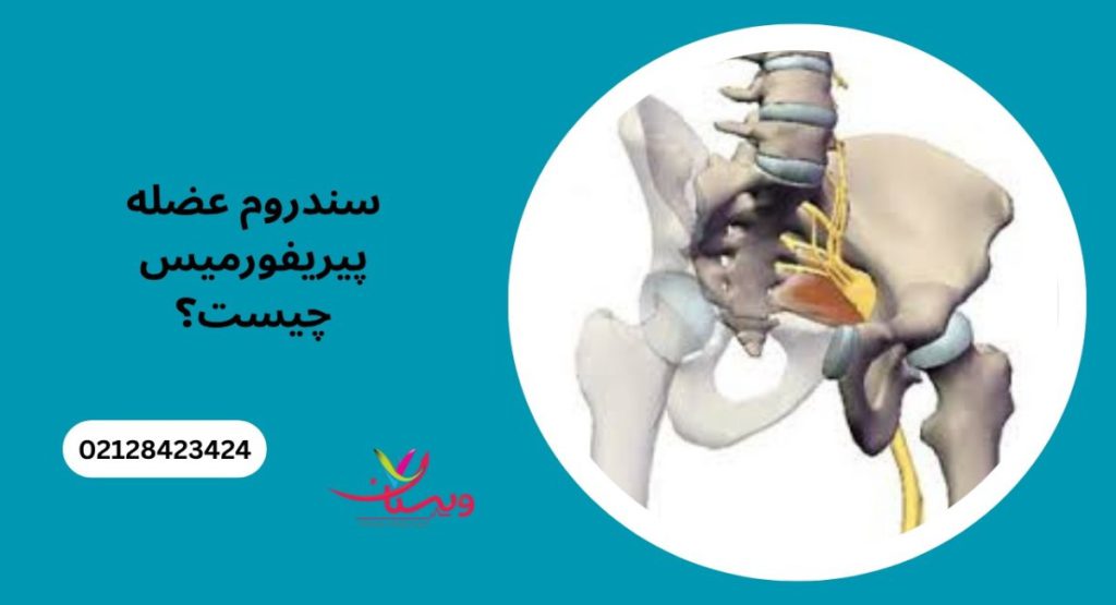 سندروم پیریفورمیس چیست؟ سندرم پیریفورمیس چیست؟