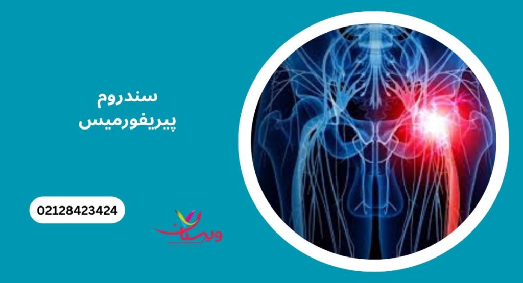 علل ایجاد سندروم پیریفورمیس علل ایجاد سندروم پیریفورمیس