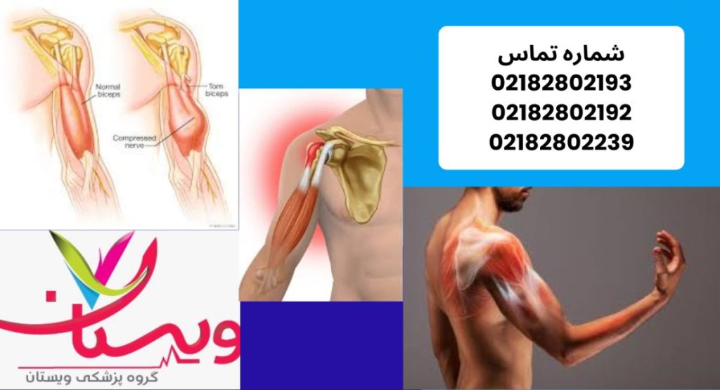 تاندونیت دوسر بازو