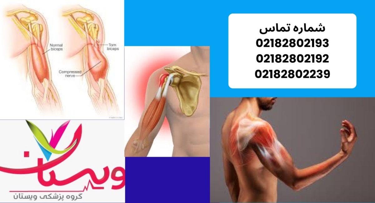 تاندونیت دوسر بازو