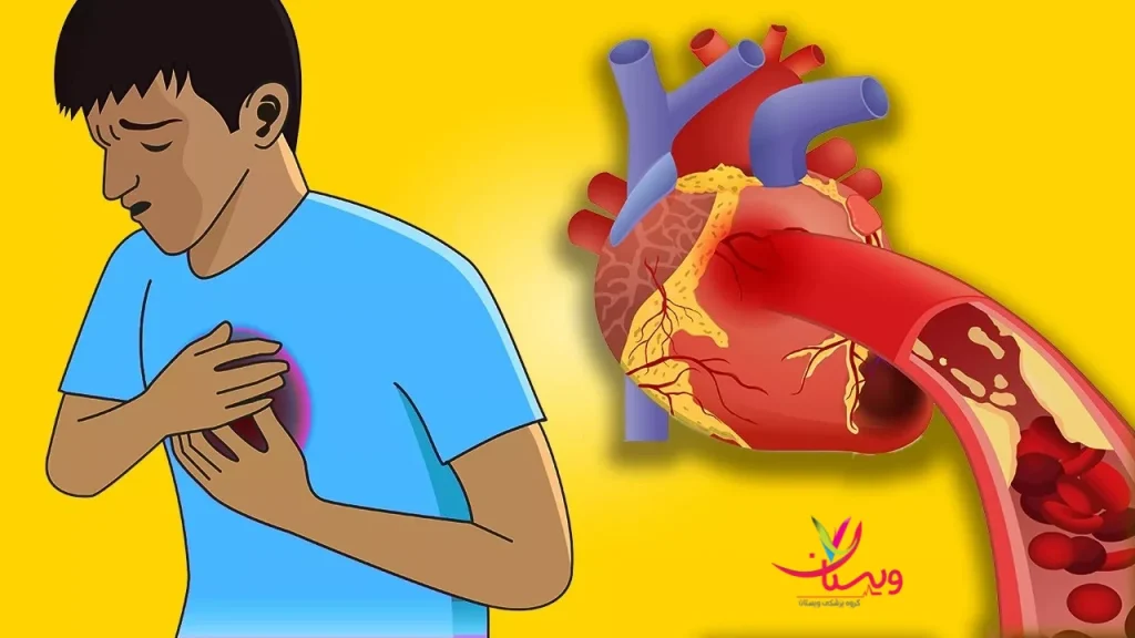 تفاوت سکته قلبی با آنژین در نوجوانان