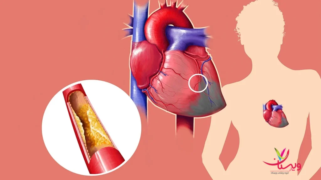 تفاوت سکته قلبی با آنژین در گرفتگی رگ ها