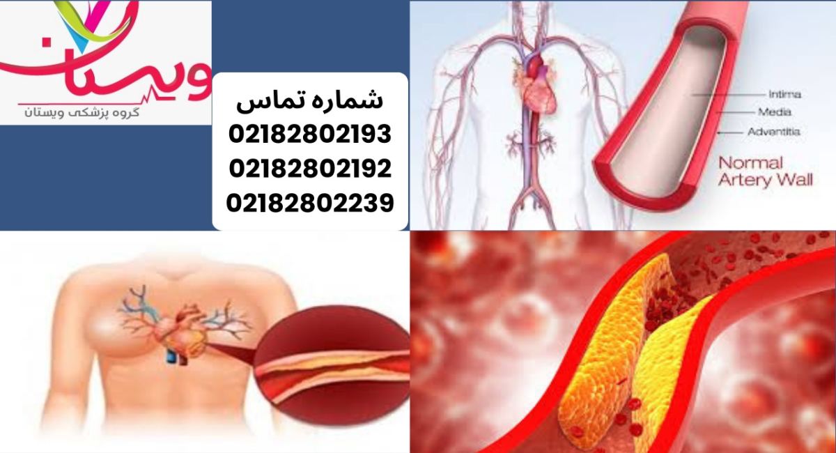 رسوب کلسیم در قلب و تاثیر بر دقت سی تی آنژیوگرافی 1404