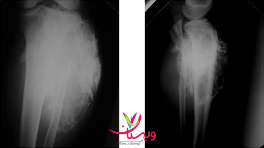 تفسیر نتایج اسکن استخوان سرطانی