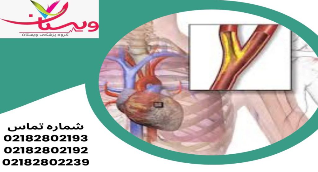 تشخیص آنژین قلبی تشخیص آنژین قلبی
