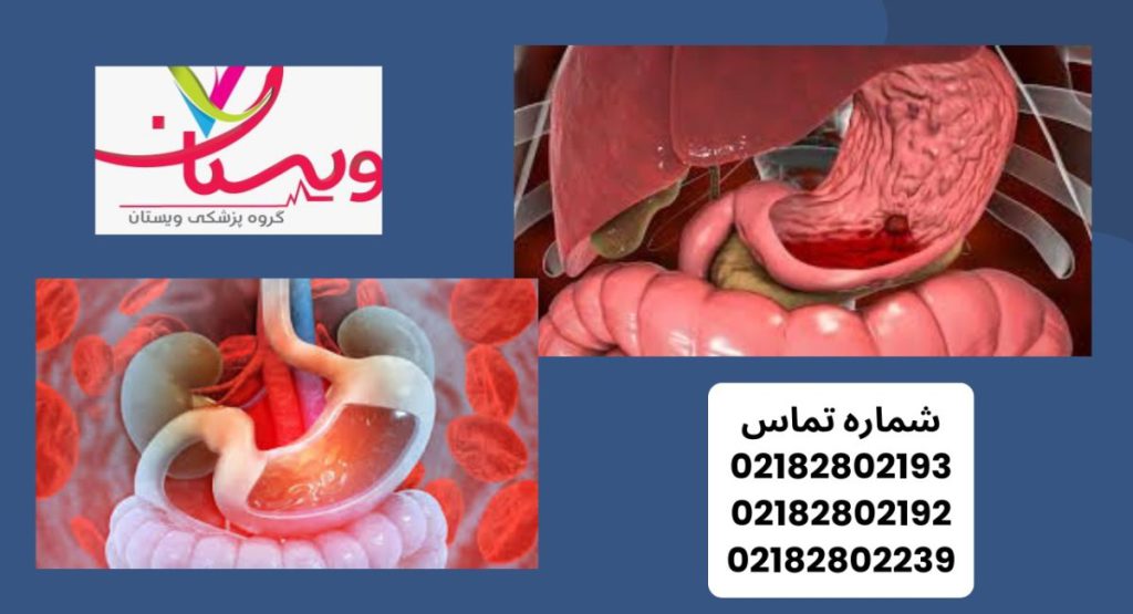 خونریزی معده چیست؟