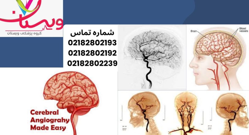 نتایج آنژیوگرافی مغز به چه معناست؟ نتایج آنژیوگرافی مغز به چه معناست؟