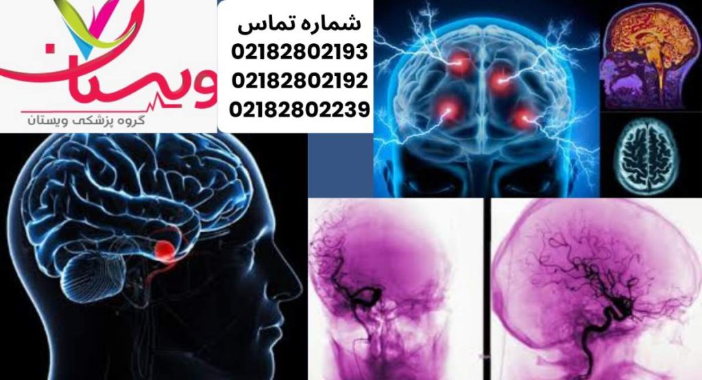 آنژیوگرافی مغز چیست؟