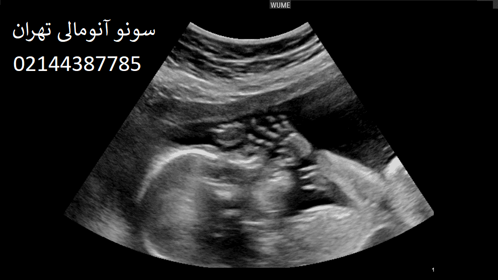 سونو انومالی اسکن برای چیست