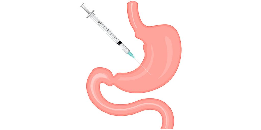 مقایسه میزان کاهش وزن: بوتاکس (موقت) در برابر اسلیو (دائمی) تفاوت بوتاکس معده و اسلیو معده | کدام برای لاغری بهتر است ؟